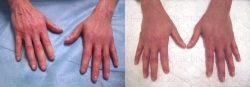 Hautregeneration mit Stammzellen an den Händen